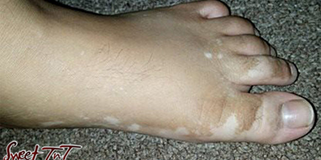 Vitiligo foot by Nerissa Hosein in sweet T&T for Sweet TnT Magazine, Culturama Publishing Company, for news in Trinidad, in Port of Spain, Trinidad and Tobago, with positive how to photography.